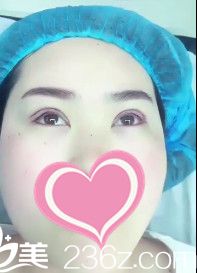 刚做完双眼皮手术的样子