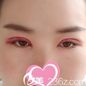 做手术2天后眼睛肿胀厉害