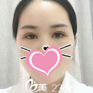 双眼皮术后5天恢复状况