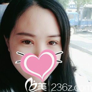 双眼皮术后7天拆线