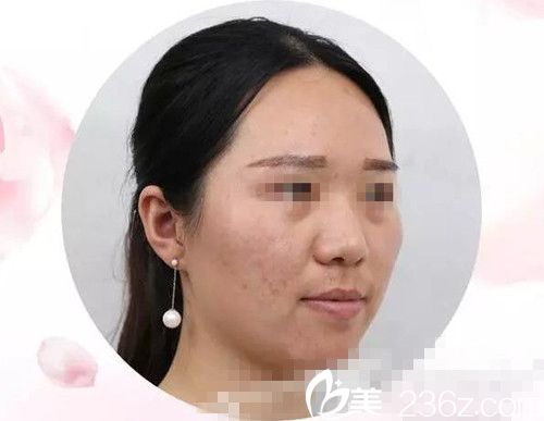 激光美肤手术三天后