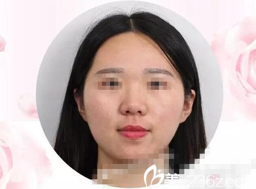 激光美肤手术7天后