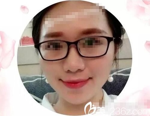 激光手术30天后
