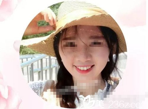 激光手术一年后