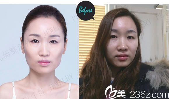 熙熙做轮廓手术前的照片