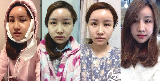 熙熙做完手术前四天的恢复图片