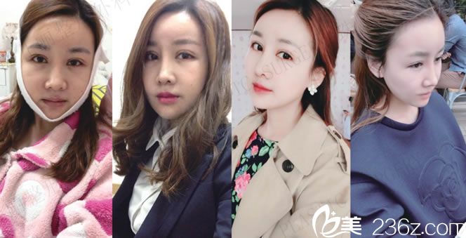 做完轮廓手术1到6周的恢复图