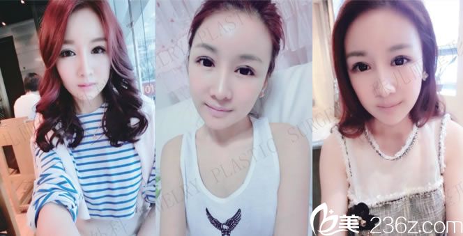 珠儿丽做完面部轮廓3月效果图