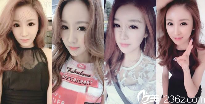 熙熙做轮廓手术变小脸的照片