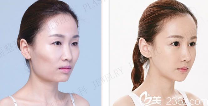 珠儿丽面部轮廓整形手术前后对比