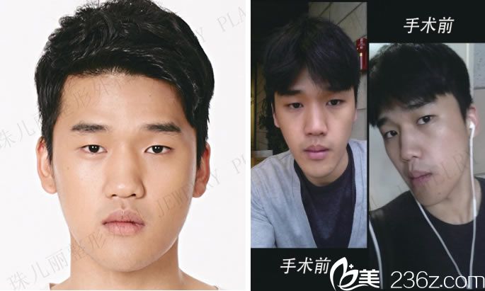 做手术前的照片 做手术前的照片