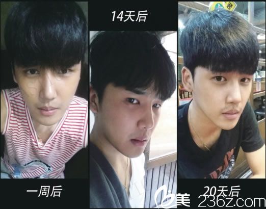 隆鼻手术前3周的效果图 隆鼻手术前3周的效果图