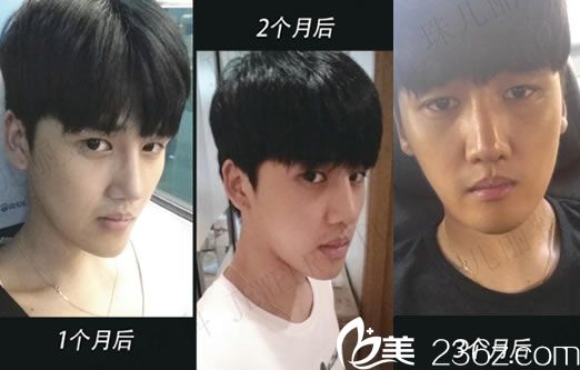 隆鼻手术3个月的效果怎么样 隆鼻手术3个月的效果怎么样