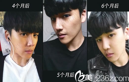 男士隆鼻手术第6个月恢复图 男士隆鼻手术第6个月恢复图