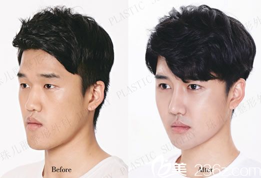 隆鼻手术前后效果对比照片