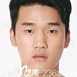 韩国珠儿丽整形医院林炯佑术前照片1