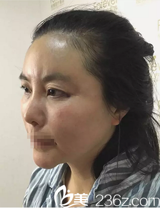 成都恒博李烈自体脂肪填充面部术后即刻效果 成都恒博李烈自体脂肪填充面部术后即刻效果