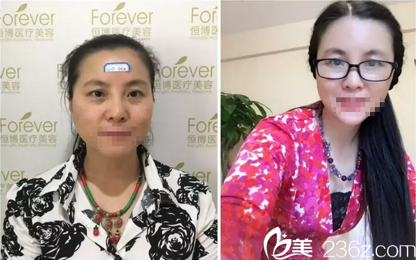 李烈面部脂肪填充术前术后对比图 李烈面部脂肪填充术前术后对比图