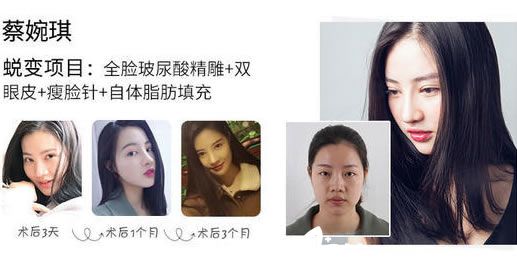 罗辉医生注射玻尿酸案例