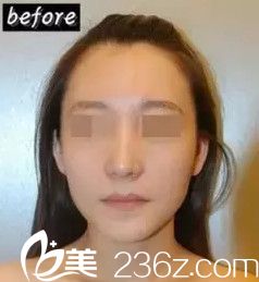 埋线提升前面部松弛无光泽 埋线提升前面部松弛无光泽