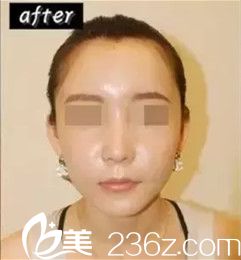 埋线提升后面部皮肤紧致有光泽 埋线提升后面部皮肤紧致有光泽
