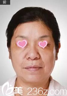 埋线提升前满脸皱纹 埋线提升前满脸皱纹