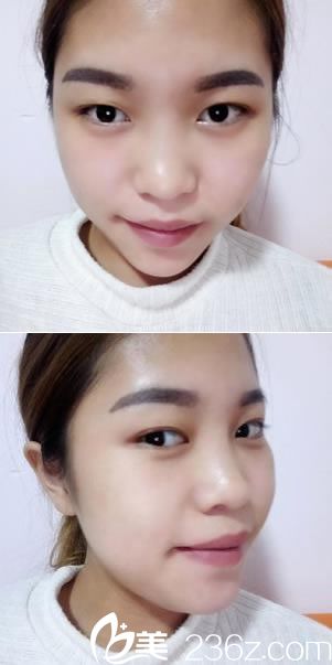 做双眼皮和隆鼻手术前的照片