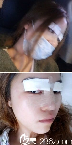 做双眼皮和隆鼻手术第2天