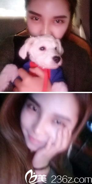 全切双眼皮手术第9天效果