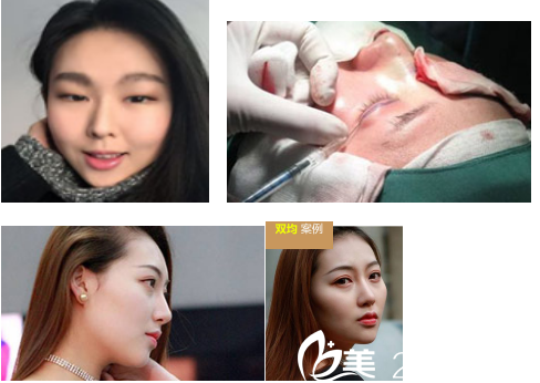 达州双均整形美容医院李双均医生做双眼皮的真人手术案例