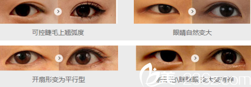 达州双均整形美容医院李双均医生做双眼皮的手术过程 达州双均整形美容医院李双均医生做双眼皮的手术过程