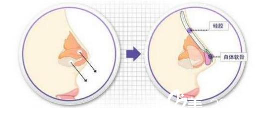 四川达州双均整形美容医院刘隆才医生隆鼻流程 四川达州双均整形美容医院刘隆才医生隆鼻流程