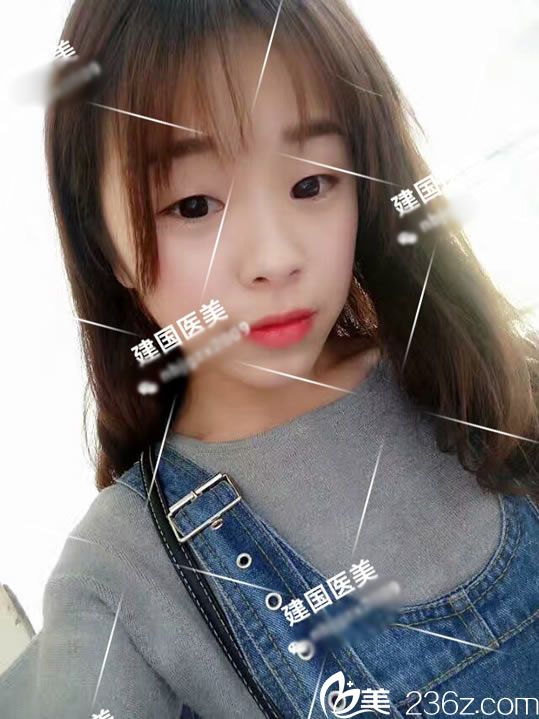 木木做双眼皮手术前的照片