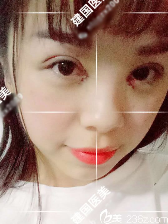 做全切双眼皮手术当天照片