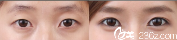 达州双均整形美容医院玻尿酸注射卧蚕的真人案例