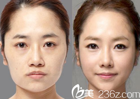 四川达州双均整形美容医院注射瘦脸的手术案例 四川达州双均整形美容医院注射瘦脸的手术案例