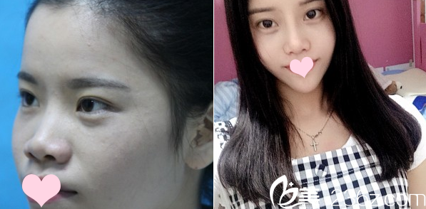 广州曙光整形医院郭建做的隆鼻案例 广州曙光整形医院郭建做的隆鼻案例