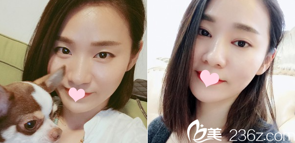 广州曙光整形医院郭建做的双眼皮案例 广州曙光整形医院郭建做的双眼皮案例