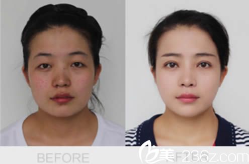 白莉双眼皮案例