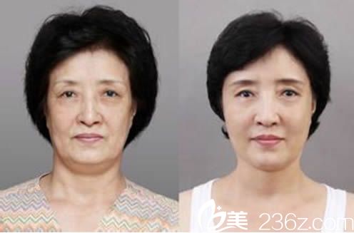 白莉面部除皱对比效果图