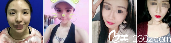 孙文强玻尿酸注射案例及面部脂肪填充案例