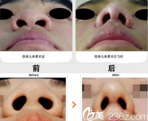 鼻翼整形隆鼻案例