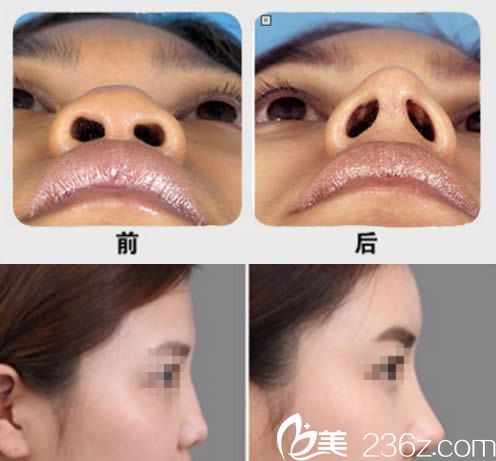 医生鼻尖整形对比图