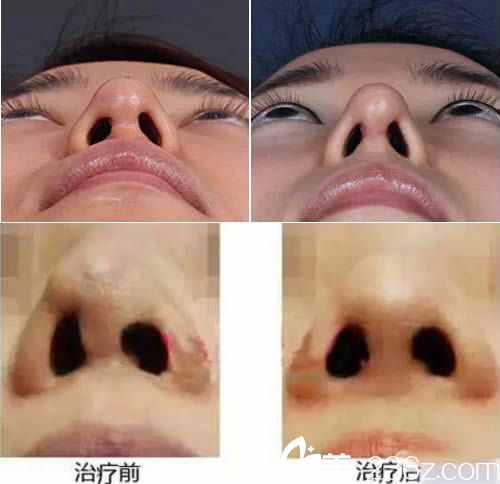 鼻修复案例图