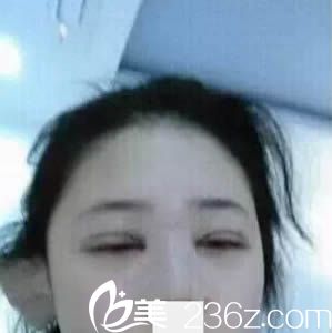 做韩式双眼皮术后当天的照片 做韩式双眼皮术后当天的照片