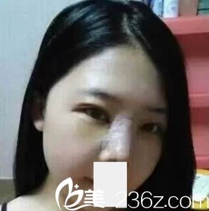 <!--<i data=20240703-sp></i>-->假体隆鼻术后4天的恢复照 <!--<i data=20240703-sp></i>-->假体隆鼻术后4天的恢复照