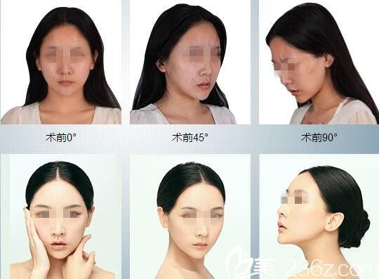 术前术后对比 术前术后对比