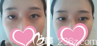 术前内双的我 术前内双的我