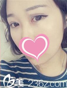 术后7天双眼皮样子 术后7天双眼皮样子