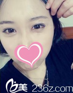 韩式双眼皮术后15天恢复情况 韩式双眼皮术后15天恢复情况